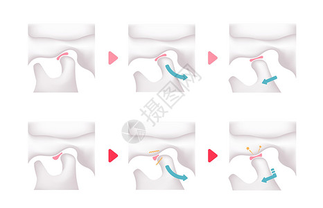 颞下区正常下巴和疾病TMD比较图科学手术外科矫正机能关节盘颅骨解剖学骨头渲染插画