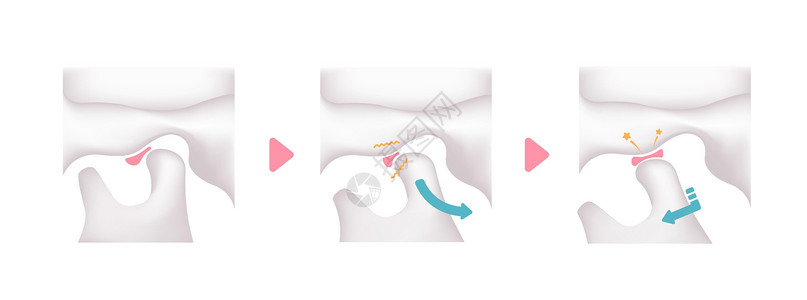 关于临时脑二膜紊乱原因的说明TMD骨骼下颌关节成形术面部颅骨药品机能疾病下巴设计图片