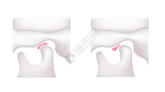 颞下区比较动脉磁盘形状正常下巴和坦波罗曼二脑紊乱的说明关节身体矫正外科骨骼障碍下颌颅骨生物学疾病插画