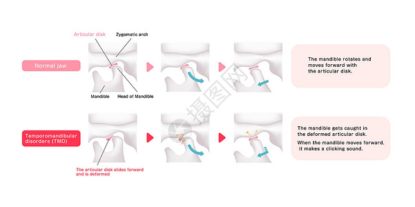 关节图正常下巴和疾病TMD比较图药品骨骼骨头解剖学关节盘颅骨外科机能科学牙科插画