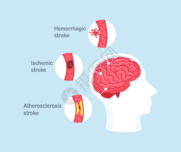 人类脑中风类型 缺血 无眼硬化和出血性中风疾病中风卫生静脉保健压力血管科学细胞图表病人背景图片