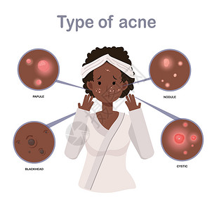 瘢痕疙瘩痤疮类型 脸上有痤疮的非洲裔美国女性 面部 美容 化妆品 化妆 治疗 健康 平面矢量卡通人物插画插画