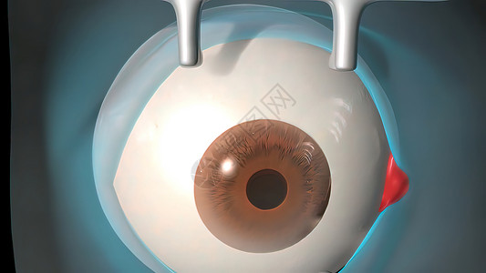 左巩膜白内障手术应用观察外科手术对人眼的观察眼球自然病人医生皮层超声视网膜眼睛胶囊萃取背景