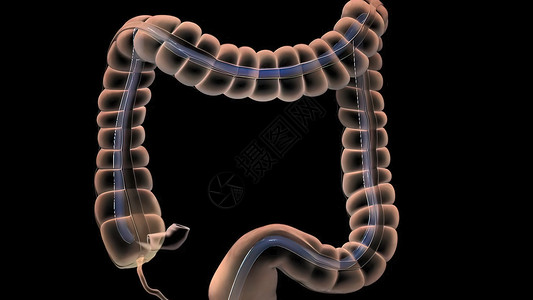人类消化系统 3D 结肠镜检查程序插图外科动画诊断器官监视器乐器药品结肠炎预防检测背景图片