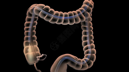 大肠息肉人类消化系统 3D 结肠镜检查程序插图息肉检查大肠药品结肠炎乐器监视器动画外科预防背景