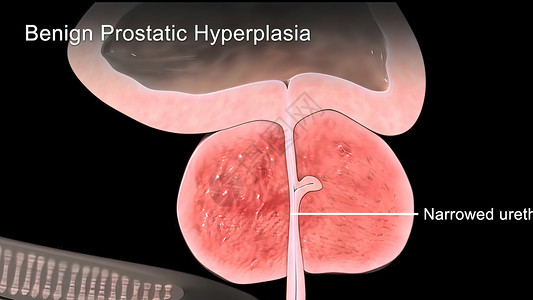 尿频尿急3d医用3d医学男士尿频男性前列腺组织疾病痛苦健康状况生殖系统背景