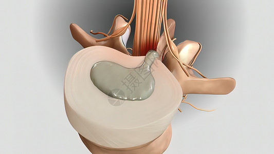 脊柱骨折导致神经压力施加于神经部位的气压身体解剖学治疗椎骨循环光盘手术药品胸椎疗法背景图片