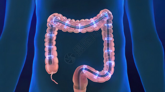 结肠息肉人类消化系统 3D 结肠镜检查程序插图检查器官息肉药品大肠乐器冒号外科手术消化背景