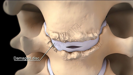 拆除被损坏的盘片 代之以金属盘片韧带生物学手术静脉整脊神经脖子系统脊柱疼痛背景图片
