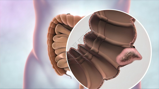 结肠息肉肠癌放大镜肿瘤的形成和发育 a 癌症大肠监视器插图剪辑检测乐器消化测试药品相机背景