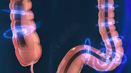 大肠息肉人类消化系统 3D 结肠镜检查程序插图诊断器官监视器息肉动画药品结肠炎解剖学乐器讨论背景