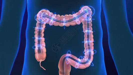 结肠息肉人类消化系统 3D 结肠镜检查程序插图预防诊断冒号病理监视器检测内窥镜结肠炎动画检查背景