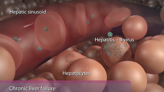 B型肝炎病毒造成的慢性肝衰竭肝炎手术外科男性图表药品胆囊器官黄疸疼痛背景