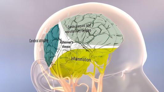 突出前神经元Amyloid 前体蛋白质剂加工和阿尔茨海默氏病神经元疾病牌匾插图纤维手术生物3d衰老精神背景