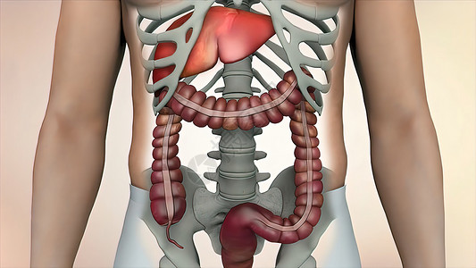在肠道或肠道癌肿瘤可见的肠透镜检查中 结肠结肠癌研究疼痛手术治疗附录冒号卫生消化解剖学药品背景图片