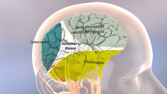 动画帧图素材Amyloid 前体蛋白质剂加工和阿尔茨海默氏病老化多肽艺术品癌症失智生物牌匾健康神经元插图背景