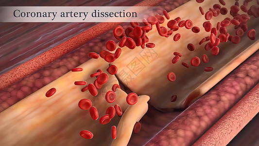 冠状动脉抽搐是这些动脉之一的短暂 突然缩小攻击危险动脉硬化营养牌匾心脏病学凝块医学心血管压力背景图片