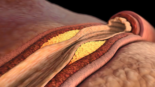 胆固醇高冠状动脉抽搐是这些动脉之一的短暂 突然缩小油炸科学心脏病学动脉硬化封锁心血管牌匾压力血块凝块背景