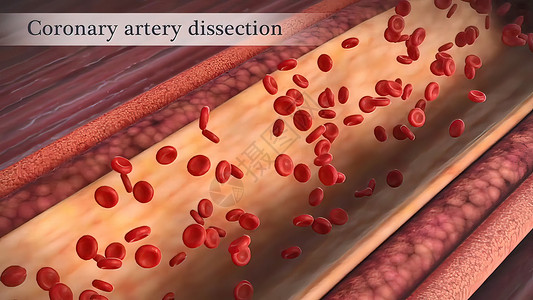 冠状动脉抽搐是这些动脉之一的短暂 突然缩小油炸凝块动脉硬化中风科学攻击营养肥胖药品细胞背景图片