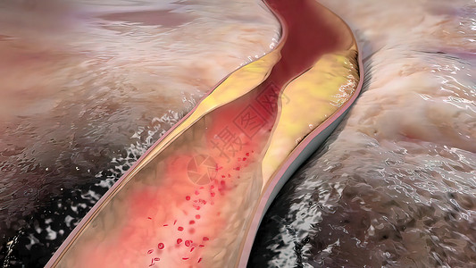 将动脉与石碑连在一起牌匾科学血块细胞心脏病学动脉粥样硬化药品疾病营养医学背景图片