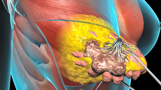 致癌物质心脏肿瘤生长的外科手术乳腺医生身体插图腺体艺术品科学女性化疗水晶背景