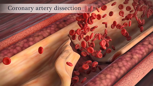 血管图片冠状动脉抽搐是这些动脉之一的短暂 突然缩小医学封锁动脉硬化牌匾血块心脏病学血管油炸细胞中风背景
