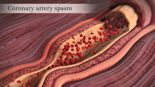 血管痉挛冠状动脉抽搐是这些动脉之一的短暂 突然缩小饮食细胞危险动脉粥样硬化心血管营养肥胖血块凝块医学背景