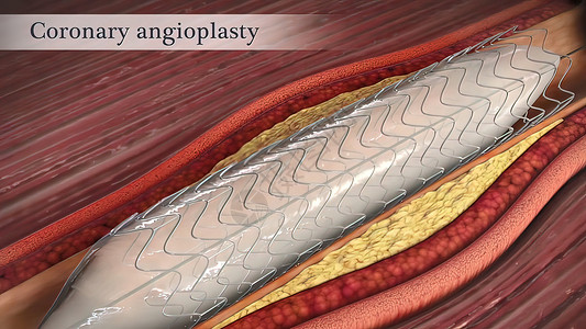 冠状血管成形器打开了较窄的冠状动脉中风细胞科学危险牌匾血块压力动脉血管心脏病学背景图片
