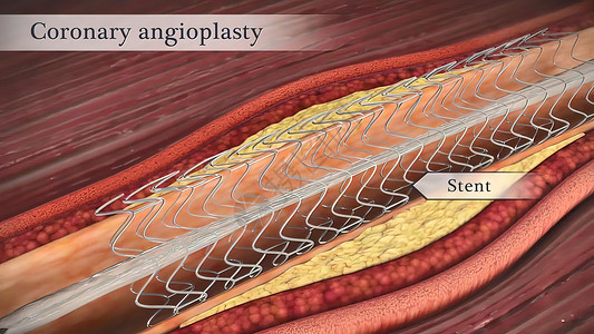 冠状血管成形器打开了较窄的冠状动脉危险药品中风动脉粥样硬化动脉医学细胞饮食肥胖心血管背景图片