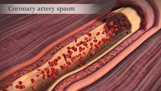 冠状动脉抽搐是这些动脉之一的短暂 突然缩小血块动脉硬化凝块肥胖动脉粥样硬化科学心脏病学血管危险饮食背景图片
