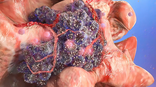 肿瘤发育阶段 3D医疗格式修辞疾病病理化学微生物药品生物学球形运动背景