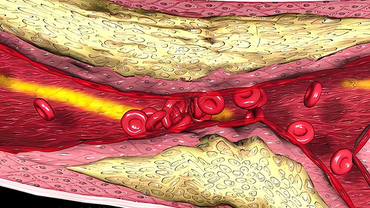 显微摄影显示含有胆固醇的凝固性醇斑块化学插图血流教育凝块红细胞人体生理细胞插头背景图片