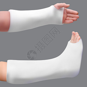 固定化抹灰的腿和手臂 治疗断腿和断臂 医药卫生 孤立的现实对象 向量设计图片