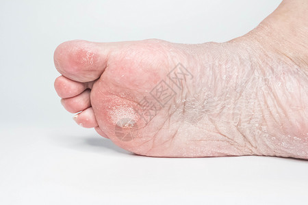 六脚趾近身的雌女性脚部皮肤酸痛 干高跟鞋孤立在白色背景上疾病女孩脚趾皮肤科女性赤脚裂缝治疗女士疼痛背景