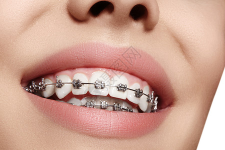 有牙套的美丽的白牙 牙科护理照片 女人微笑与矫形配饰品 整形治疗女性女士美白牙医牙齿矫正医生口腔科制品成人背景图片