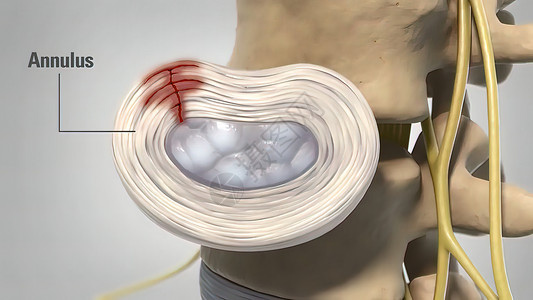 3d 医疗治疗疾病系统脊柱脊髓骨赘状况磁盘神经器官疼痛动画背景图片