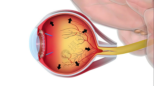 神经肌肉再教育Glaucoma是一种眼睛状况 它损害光神经 对良好的视力至关重要保健教育3d黄斑科学结膜肌肉角膜手表脉络膜背景