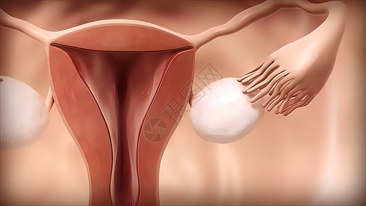 子宫内膜异位3D 医学插图 女性生殖系统 月经周期腹痛子宫技术女士电话伤害月经腹部压力症状背景