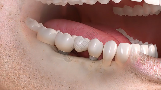 牙科移植手术牙龈制品药品解剖学口腔科安装陶瓷治疗外科微笑背景