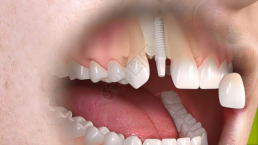 牙科移植手术矫正插图外科口腔科假牙凹痕制品安装治疗磨牙背景