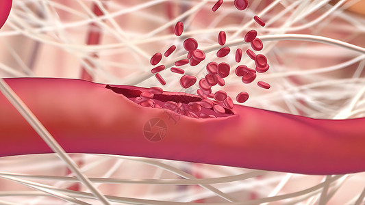 内出血是创伤最严重的后果之一支气管静脉器官解剖学动脉殴打心血管气管男人尿液背景图片
