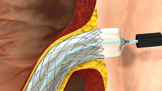 冠脉3d 冠心血管动脉造动程序流动保健树干系统科学静脉男人肌肉卫生生活背景