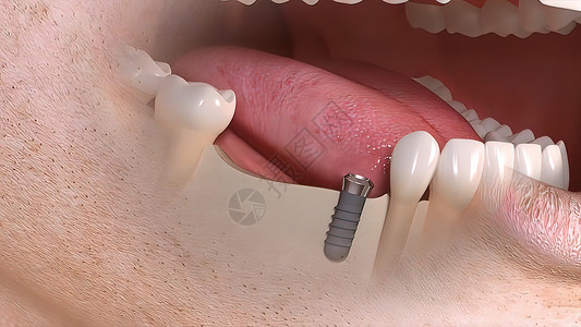 牙科移植手术磨牙安装口腔科矫正风俗牙医组装插图解剖学陶瓷背景