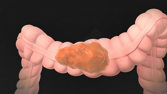 灌肠人类消化系统解剖消化植物群结肠同化科学盲肠肠道食管药品打扫背景