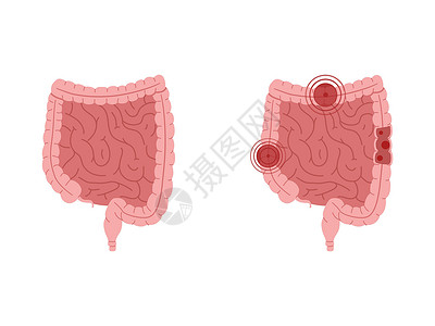 回肠健康肠胃和有炎症的肠胃的平方矢量说明 (单位 百万分之一)插画