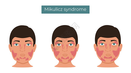 Mikulicz综合症的矢量说明 扩大粪便和口腔腺设计图片