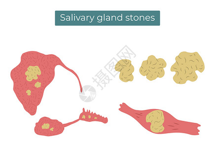腮腺以矢量平方显示在 亚管和亚语言的盐状腺和管道中的石块插画
