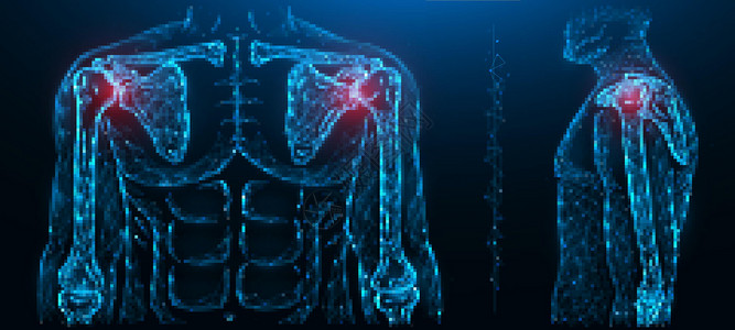 肩关节疼痛的多边形矢量图解 肩关节疾病 人体肌肉骨骼系统疾病背景图片
