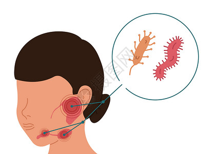 腮腺一位患有唾液腺细菌炎的妇女 用矢量说明西雅洛叶丝虫病插画