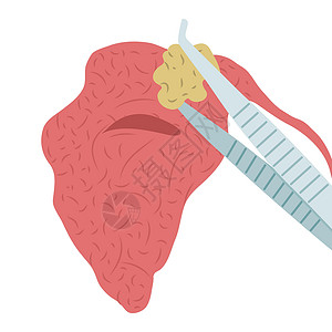 将一块石头从盐酸盐的流利腺中除去的矢量插图高清图片